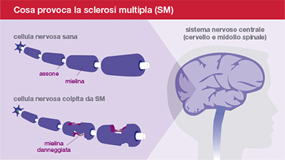  cos è la sclerosi multipla