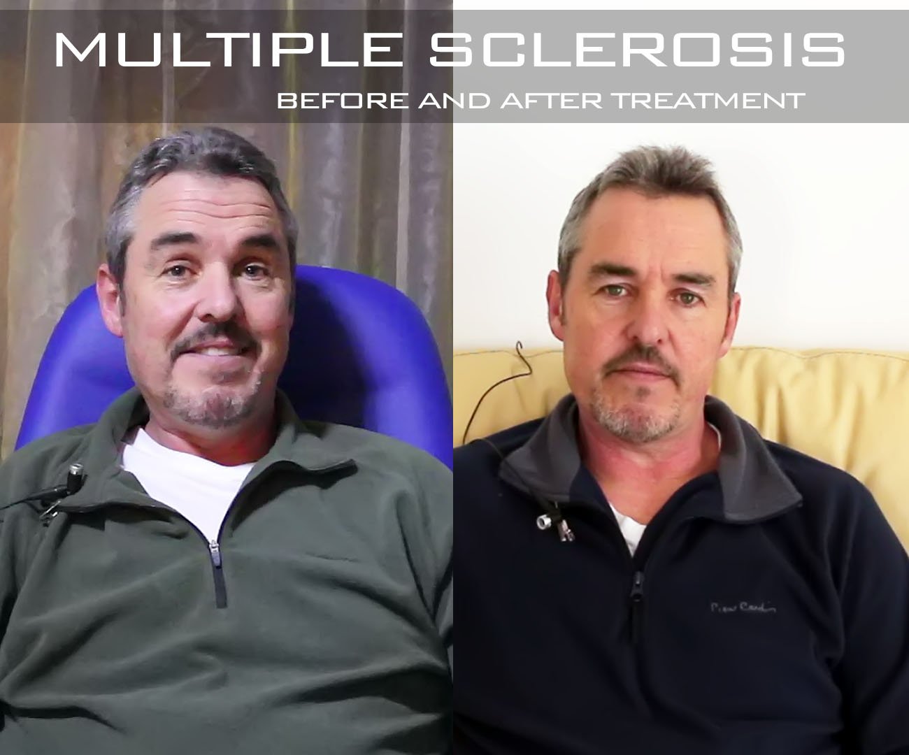 prima e dopo il trattamento della sclerosi multipla
