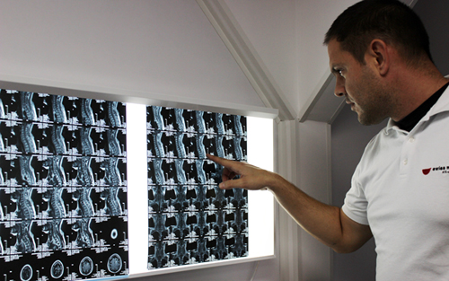 Colonna vertebrale mri Sclerosi multipla colonna vertebrale